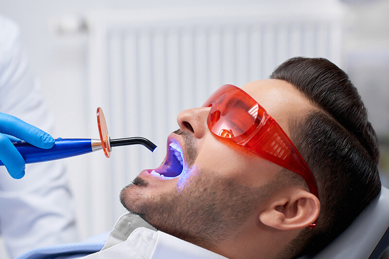 Dental Fillings